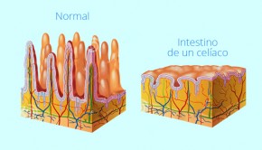 biopsia-celiaquia-celiaco-prueba
